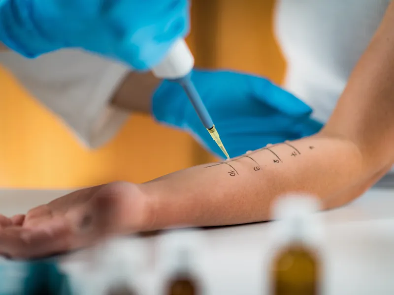 Behandschuhte Hand tropft mit einer Pipette Testlösung auf den markierten Unterarm