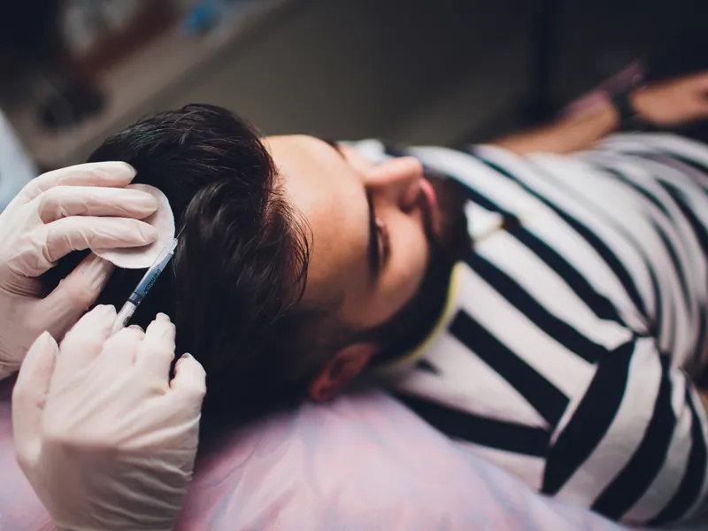 Injektion in die Kopfhaut zur Anregung des Haarwachstums