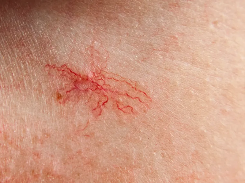 Makroaufnahme eines roten Punktes mit feinen, verzweigten Äderchen auf der Haut