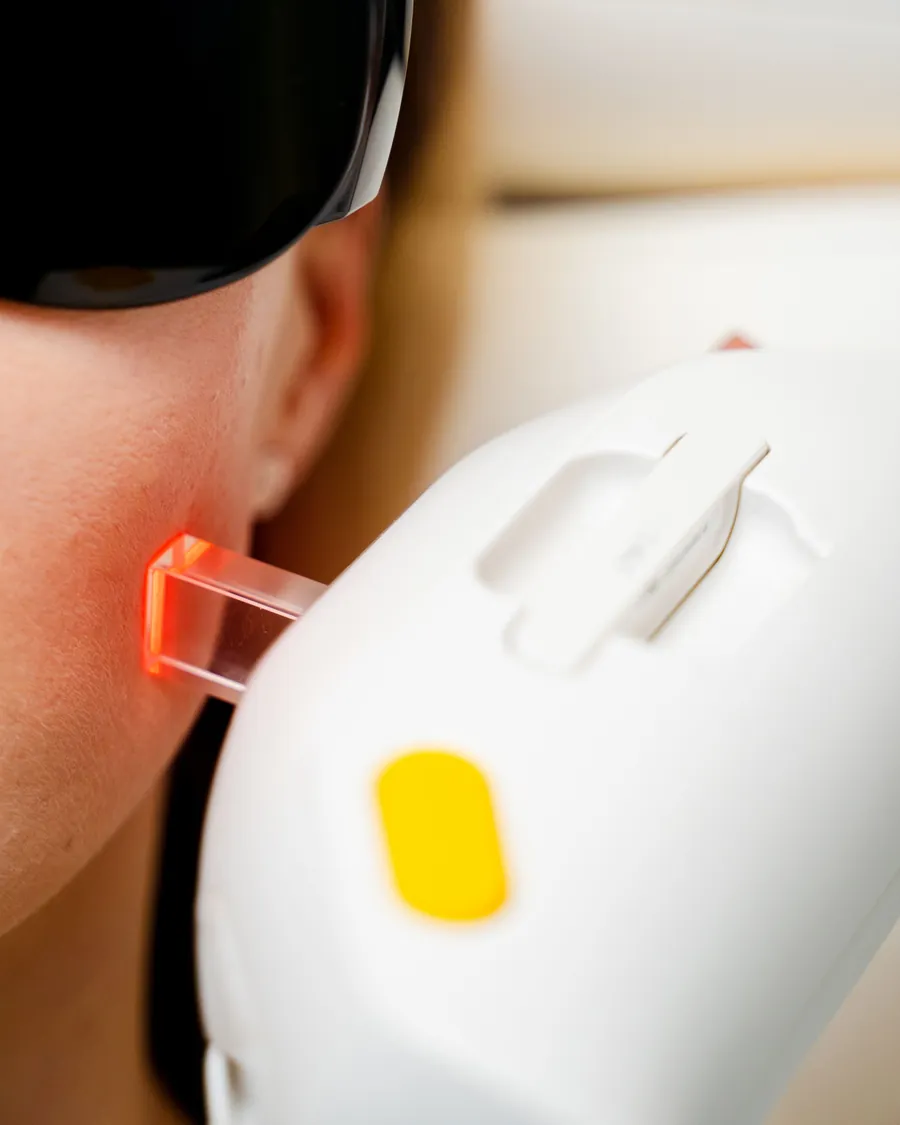 Markenloses Laser-Handstück mit leuchtender Spitze dicht an der Wangenhaut
