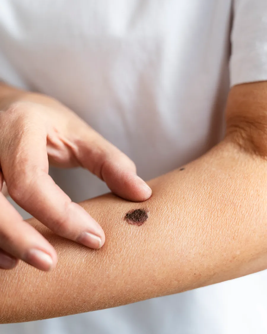 Fingerspitze zeigt auf ein dunkles Muttermal am Unterarm