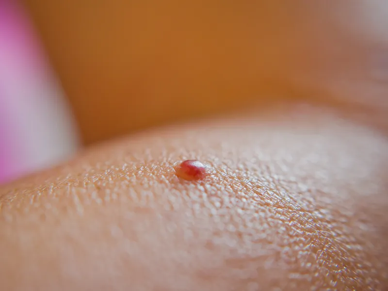 Makroaufnahme eines kleinen kirschroten Gefäßknötchens auf der Haut