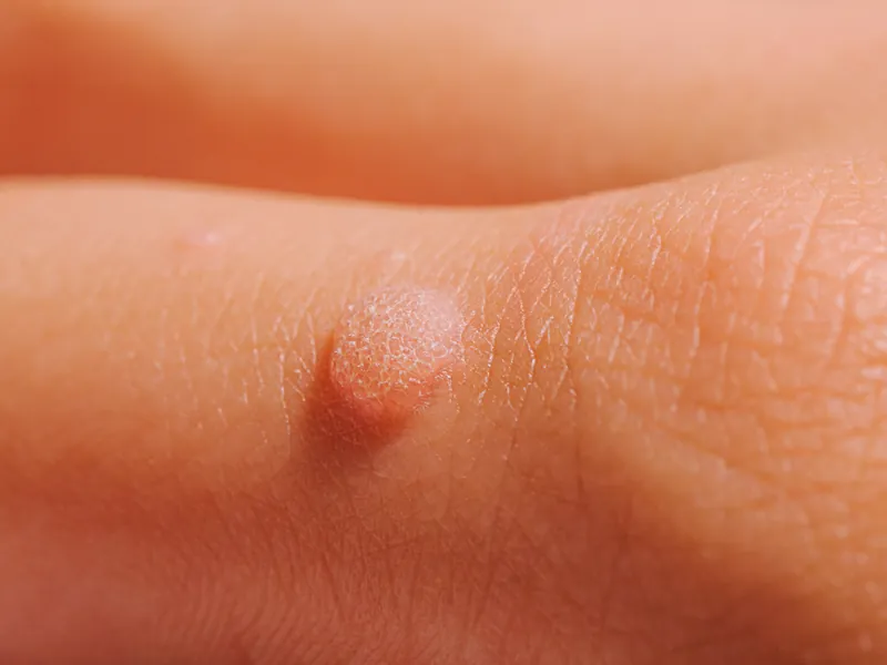 Makroaufnahme einer kleinen Warze auf dem Handrücken
