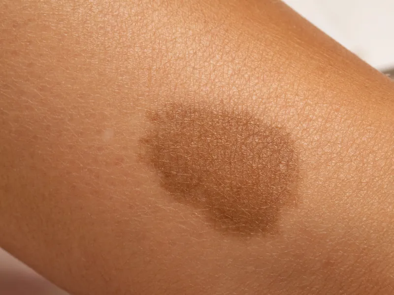 Großer gleichmäßig hellbrauner Café-au-Lait-Fleck auf der Haut am Bein