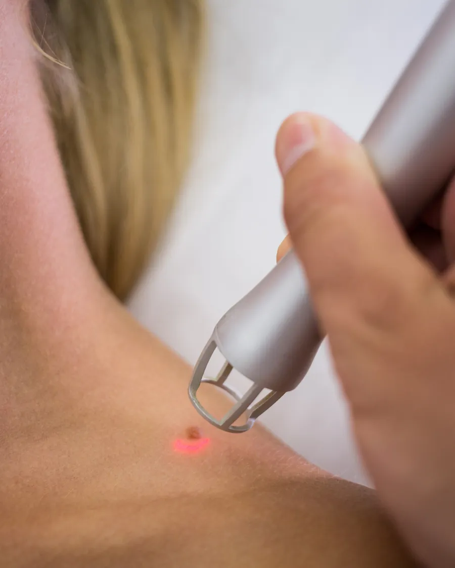 Entfernung einer Hautveränderung an der Schulter mit einem Lasergerät