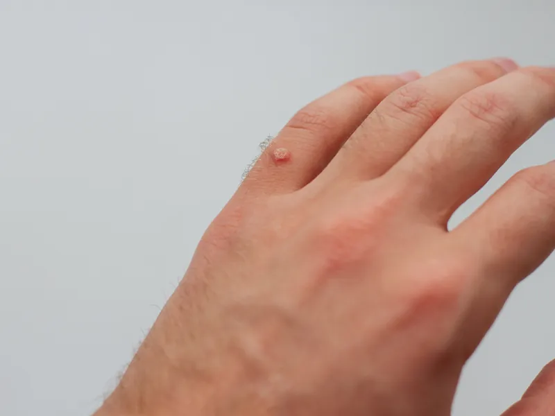 Nahaufnahme eines Handrückens mit einer kleinen, flachen Warze am Fingergrundgelenk
