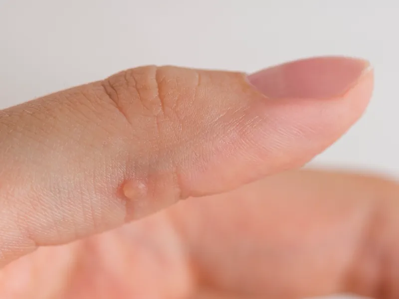 Nahaufnahme eines Fingers mit einer kleinen erhabenen Warze an der Seite